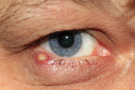infezione sul bordo degli occhi