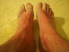 reazione allergica sui piedi