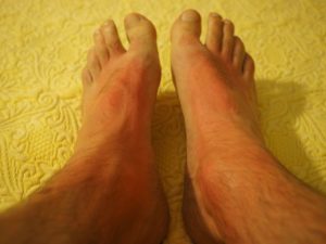 reazione allergica sui piedi