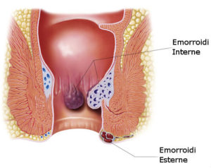 emorroidi disegno